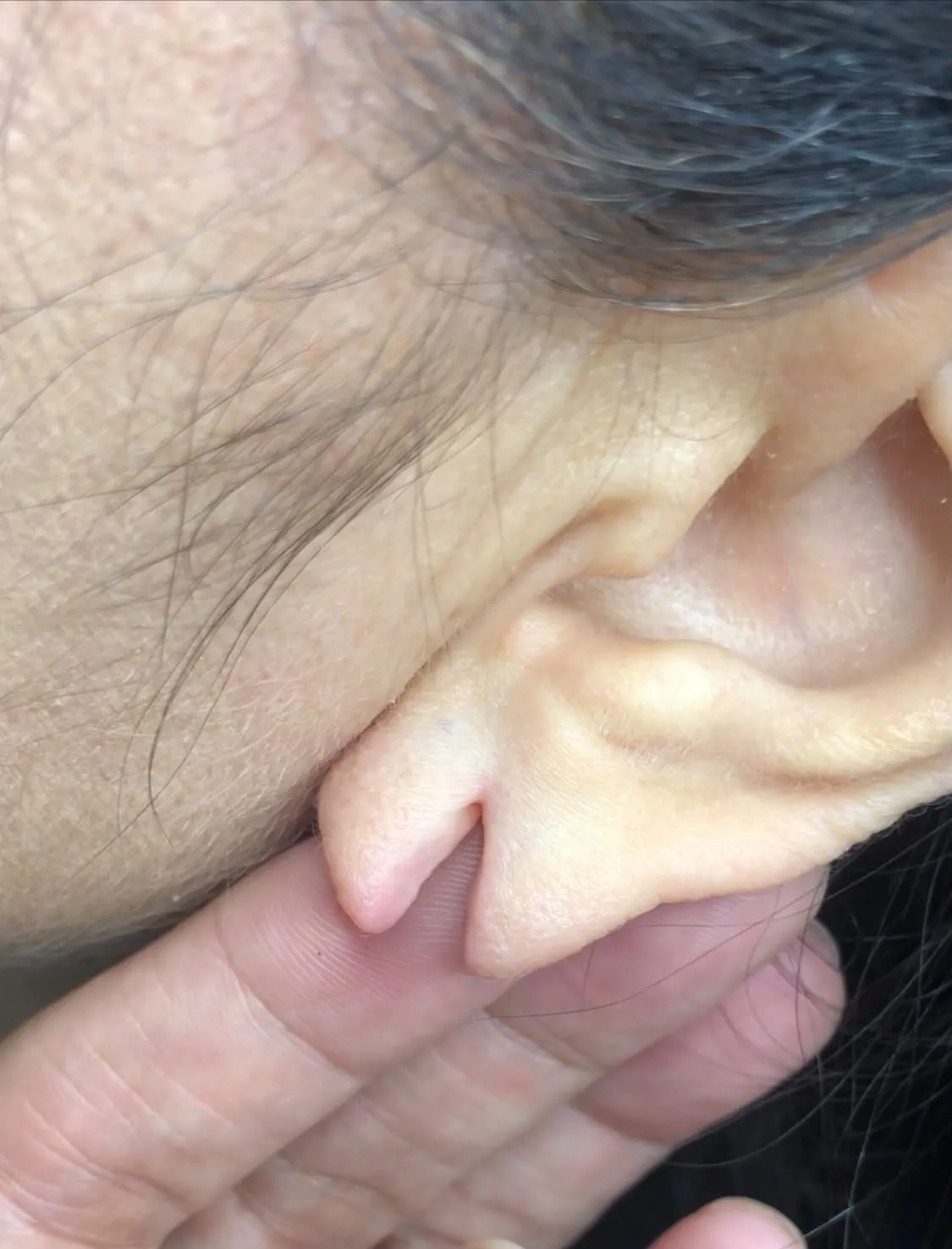 Lóbulo da orelha rasgado ao meio, antes da lobuloplastia